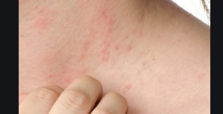 Si Puo Essere Allergici Allo Sperma