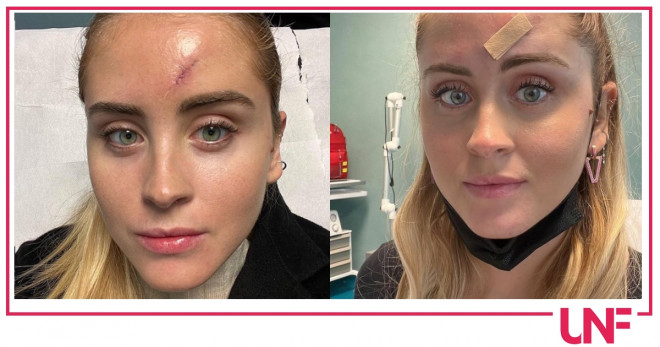 Valentina ferragni cicatrice