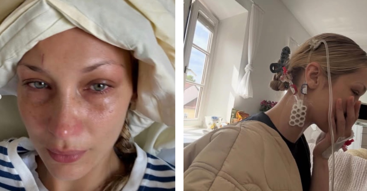 bella hadid lyme