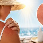 allergia al sole come riconoscerla