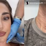 belen segni sul collo trattamento